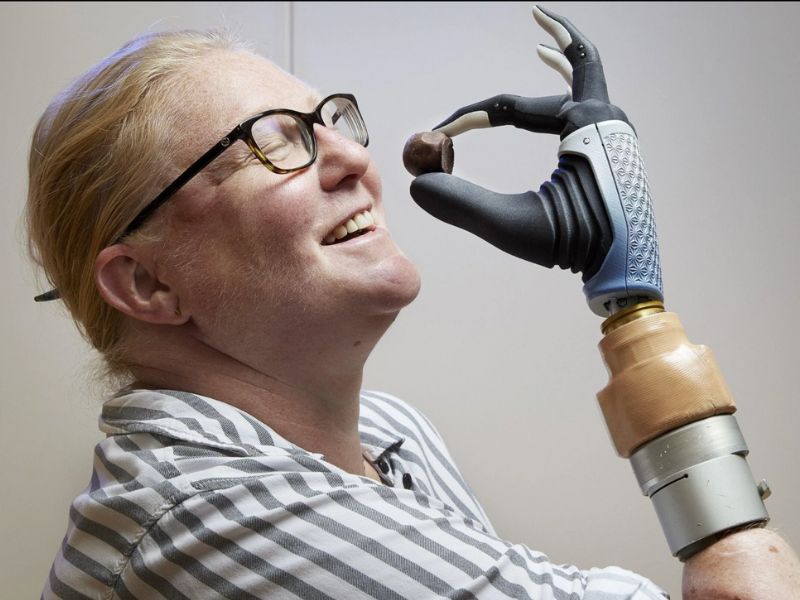 Meet the first person ever to receive a fully functional bionic hand with  AI - CyberGuy