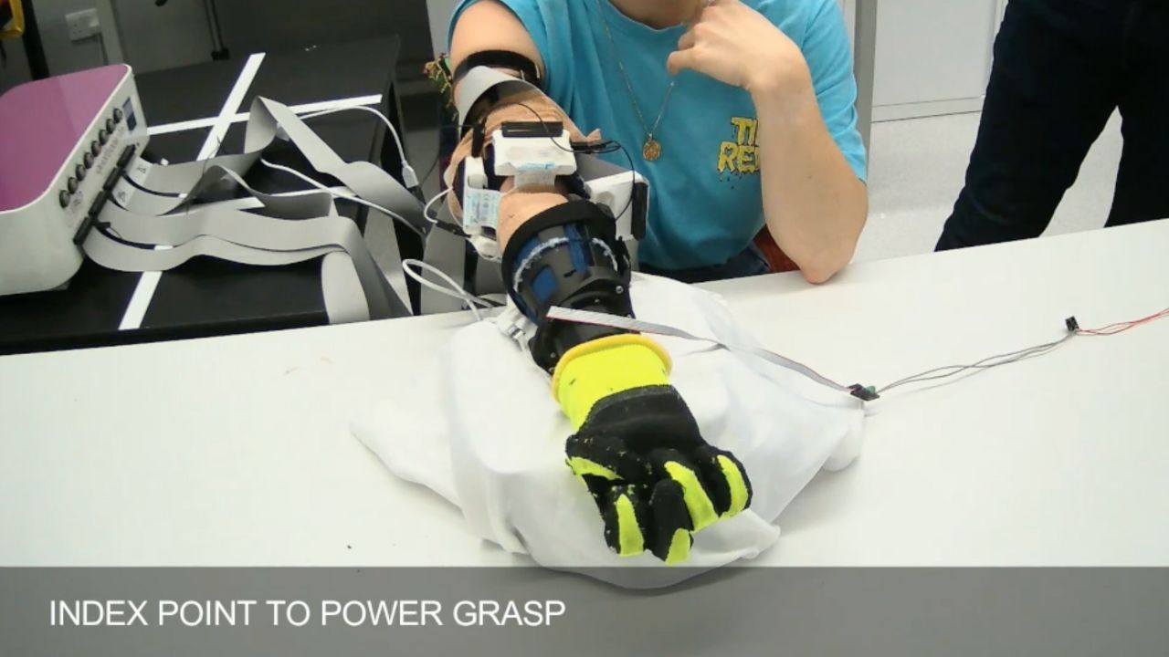 A new soft prosthetic hand designed for more intuitive control