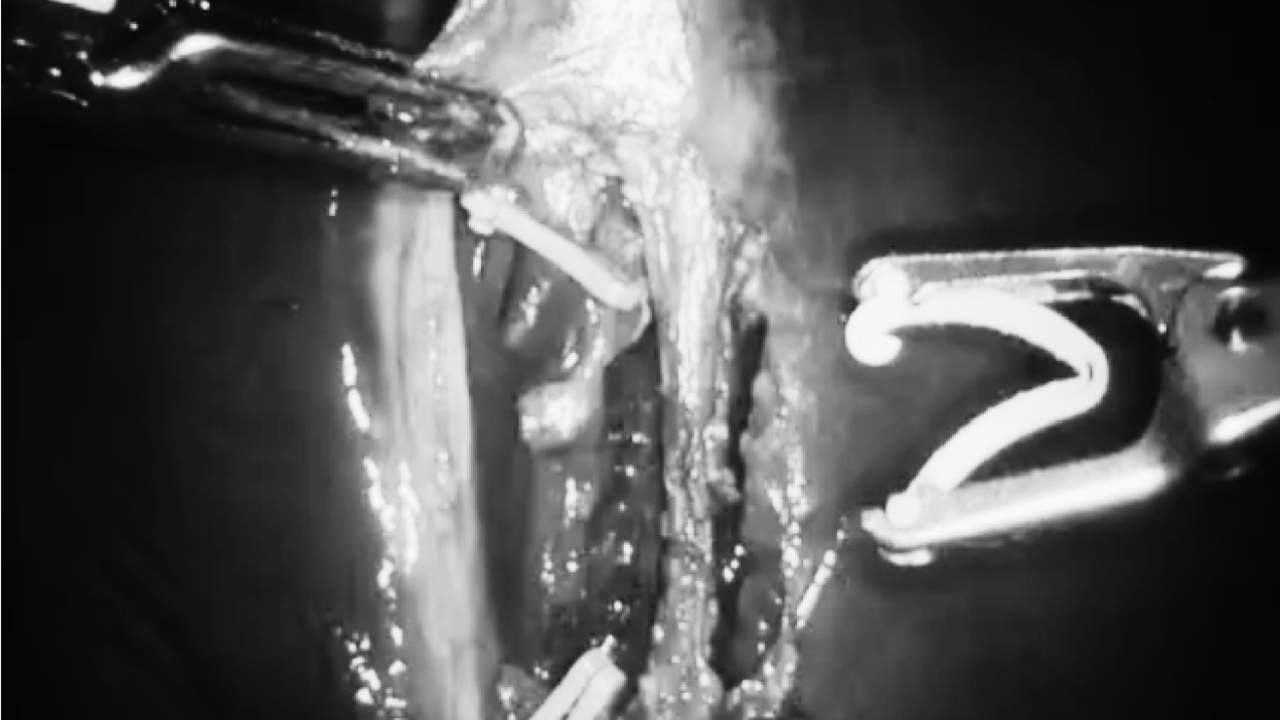 Robot performs gallbladder procedure