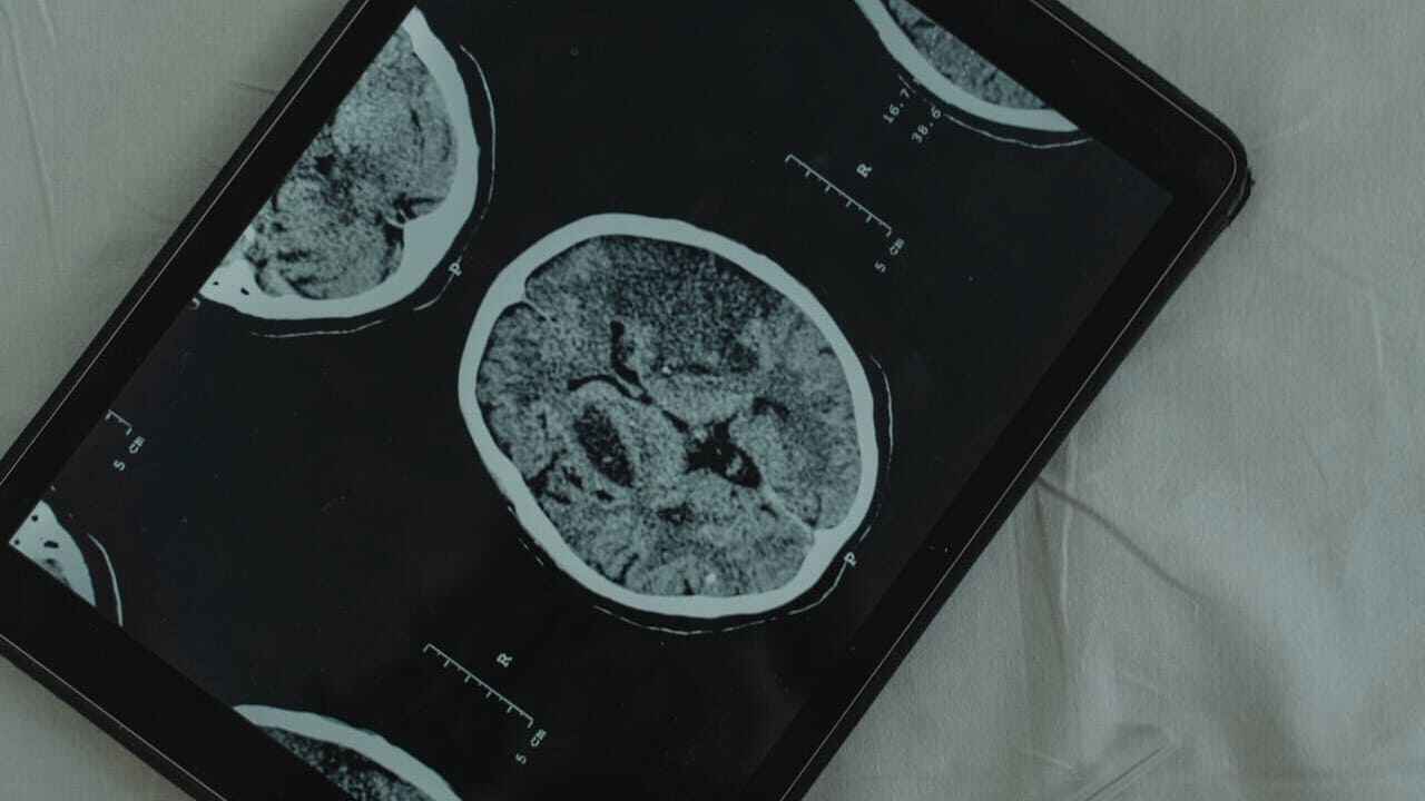 An image of a scanned brain on a tablet