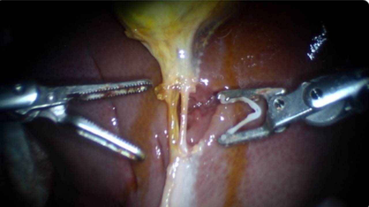 Robot performs gallbladder procedure